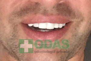 blanqueamiento dental odas