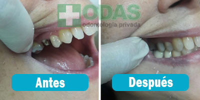 implante dental odas