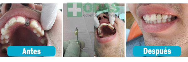 implante dental odas