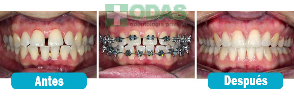 ortodoncia dental odas