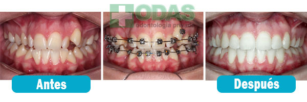 ortodoncia dental odas