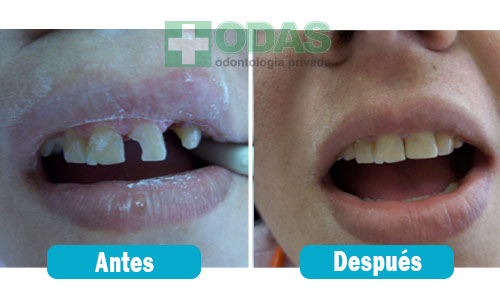 reconstruccion dental odas