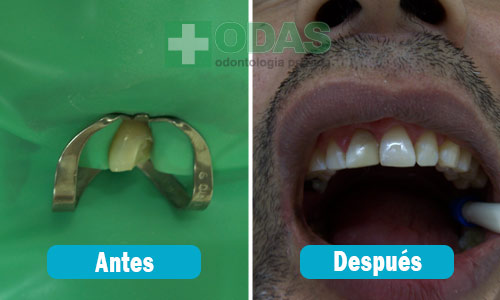 reconstruccion dental odas